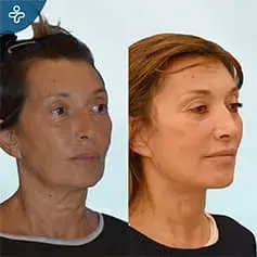 Full Neck Lift Surgery Before and After