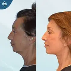 Full Neck Lift Surgery Before and After