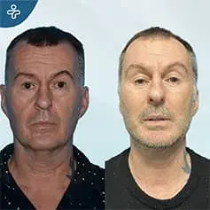 Neck Lift in Turkey Before After