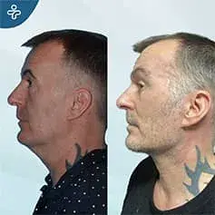 Neck Lift in Turkey Before After