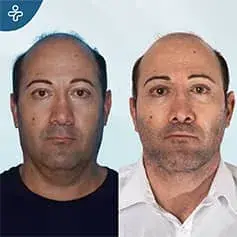 Neck Lift Dewlap Removal