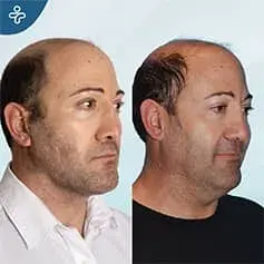 Neck Lift Dewlap Removal