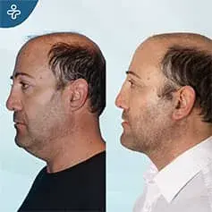Neck Lift Dewlap Removal