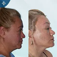 Full Neck Lift Before & After