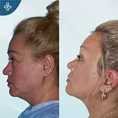Full Neck Lift Before & After
