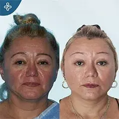 Temporal Lift 3 Months Before and After