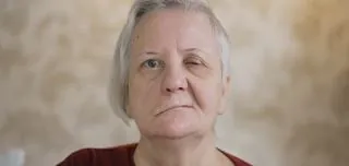 Elderly woman with one eye drooping and slight facial asymmetry, typical presentation of Bell’s palsy facial paralysis.