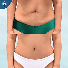 A belly button revision