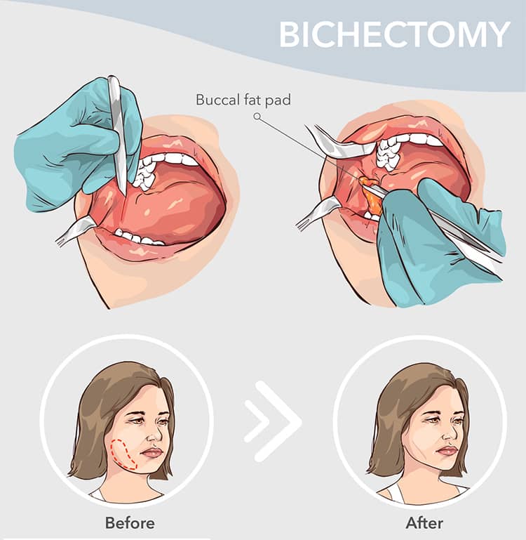 bichectomy-illustration
