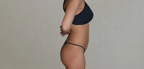Side view of woman in Turkey before body contouring surgery, showing abdomen and waist profile before reshaping procedure.