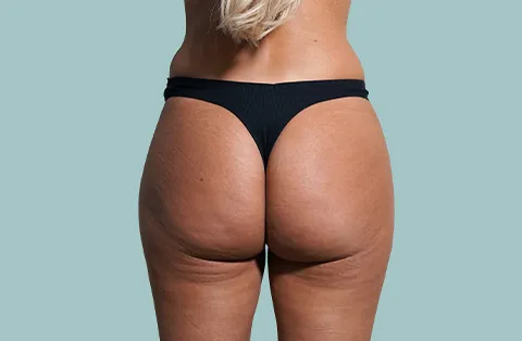 Levantamiento de Gluteos Brasileno