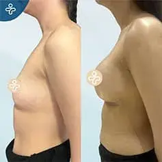 Implantes Anatómicos de Alta Proyección Antes y Después