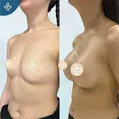 Implantes Anatómicos de Alta Proyección Antes y Después