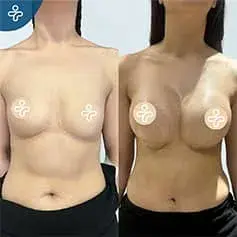 Implantes Anatómicos de Alta Proyección Antes y Después