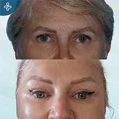 Botox Brow Lift Before and After
