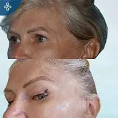 Botox Brow Lift Before and After