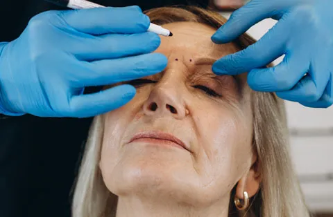 Lifting des sourcils