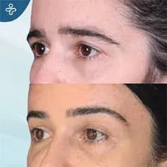 Brow Lift Surgery Before and After