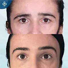 Brow Lift Surgery Before and After