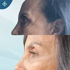 Eyebrow Lift Before and After Results