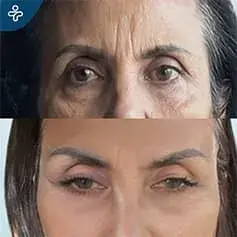 Eyebrow Lift Before and After Results