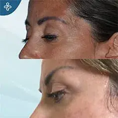 Mini Brow Lift Before and After