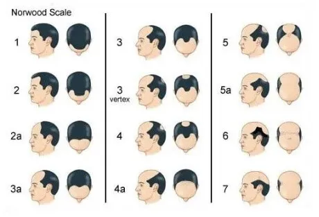norwood-scale