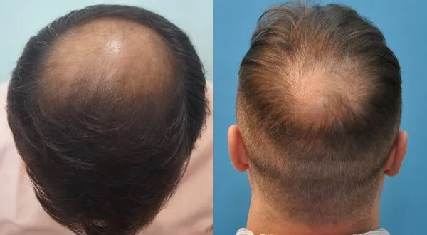 crown-hair-loss