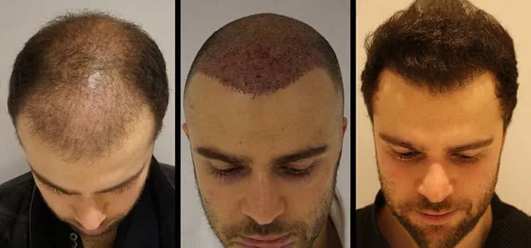 crown-hair-transplant-process-result