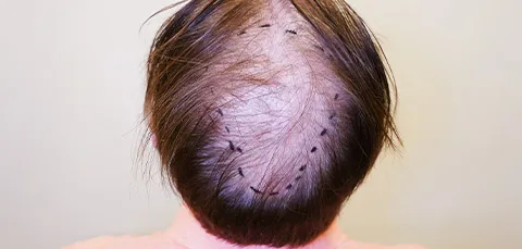 Marked crown area on mans scalp before DHI hair transplant procedure