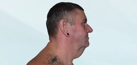 Side profile of man with double chin before cosmetic chin and neck procedure