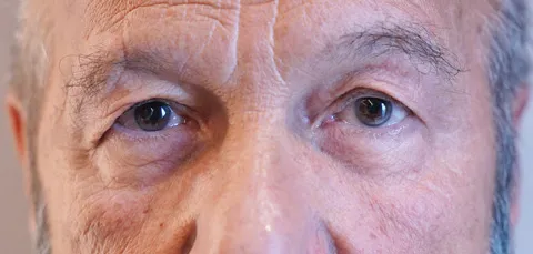 Older man after double eyelid surgery in Turkey, showing rejuvenated eye area and natural eyelid contour