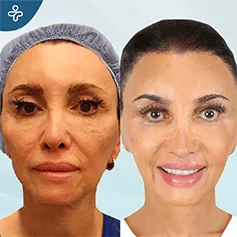 endoscopic-facelift