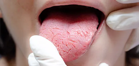 Close-up of a doctors gloved hands examining the tongue before surgery for sleep apnea
