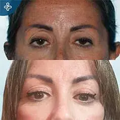 Eyelid Rejuvenation with Fat Injection Before and After