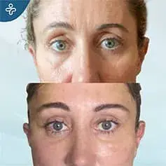 Upper Eyelid Blepharoplasty Before and After in Turkey