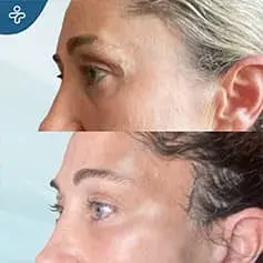 Upper Eyelid Blepharoplasty Before and After in Turkey