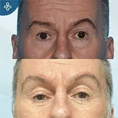 Male Upper Blepharoplasty Before and After