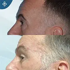Male Upper Blepharoplasty Before and After