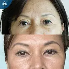 Scarless Blepharoplasty in Turkey