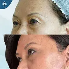 Scarless Blepharoplasty in Turkey