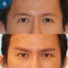 Stare Rejuvenation Before and After