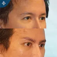 Stare Rejuvenation Before and After