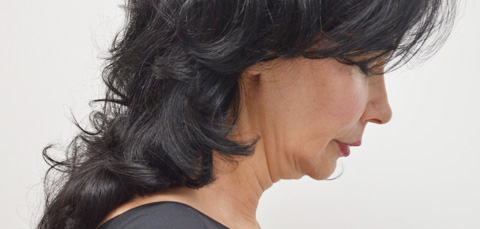 Side view of woman before face and neck lift in Turkey, showing sagging skin on jawline and neck before surgery.