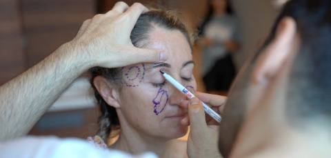 Surgeon drawing pre-op markings on woman’s face before facelift and eyelid surgery