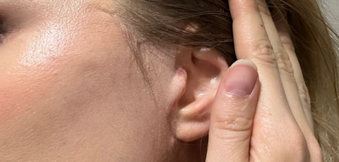 Close-up of healed facelift scar near ear after surgery in Turkey, showing minimal post-op marks