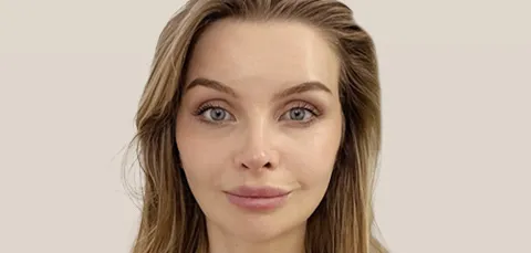 Frontal view of a woman after facelift surgery in Turkey showing smoother skin and youthful contours