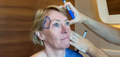 A surgeon marking a womans face to plan a facial reconstruction surgery.