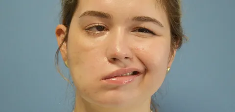 Young woman showing facial paralysis symptoms, illustrating nerve damage and treatment options in Turkey