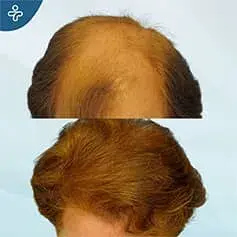 FUE Female Hair Transplant Turkey Before and After